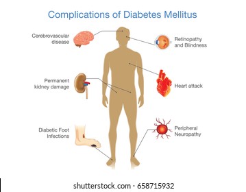 Complications of Diabetes Mellitus in people. Illustration in Infographic style about medical and health.