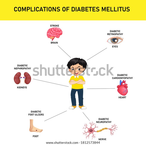 Complications Diabetes Mellitus Stroke Nephropathy Neuropathy Stock ...