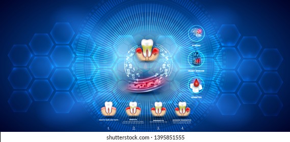 Complications of the gum disease. Bacteria from inflamed gums can enter in to the blood stream and affect other organs such as brain, heart and cause diabetes. Abstract blue scientific background.