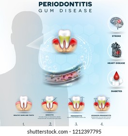 Complications Of Gum Disease, Periodontitis Detailed Illustration. Bacteria From Inflamed Gums Can Enter In To The Blood Stream And Affect Other Organs Such As Brain, Heart And Cause Diabetes