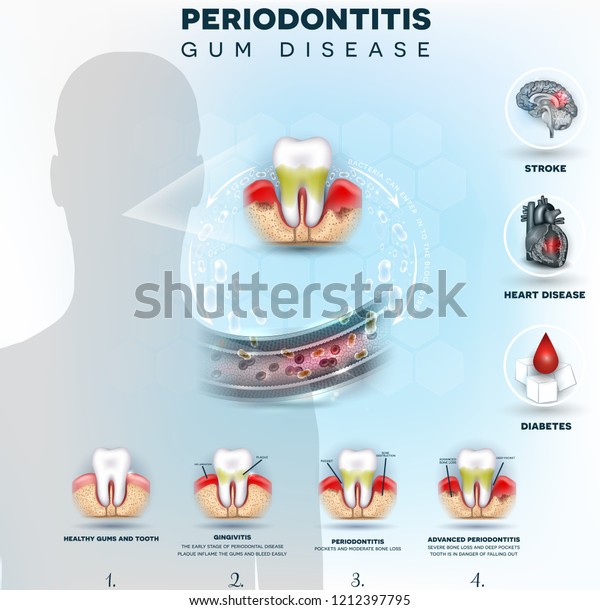 Complications of gum disease, Periodontitis\
detailed illustration. Bacteria from inflamed gums can enter in to\
the blood stream and affect other organs such as brain, heart and\
cause diabetes