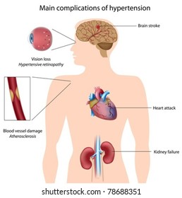Complicaciones de la hipertensión