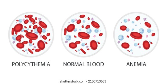 Composition Of Whole Blood: Polycythemia, Normal Blood, Anemia. Medical Vector Illustration.