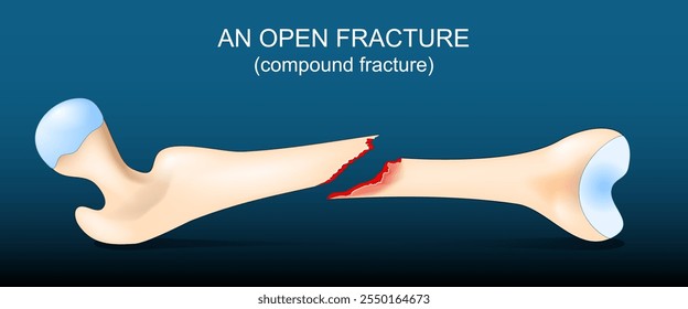 Fratura exposta do osso do fêmur. Fratura aberta. Fêmur humano quebrado em fundo escuro. Ilustração vetorial