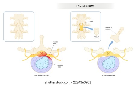 compressed back nerve lumbar of annular tear laminectomy spine cord surgery root muscle pain disc tumor cancer cyst bone spurs vertebrae weakness diskectomy anterior fusion transforaminal replacement