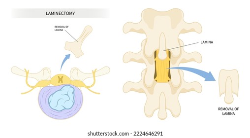 compressed back nerve lumbar of annular tear laminectomy spine cord surgery root muscle pain disc tumor cancer cyst bone spurs vertebrae weakness diskectomy anterior fusion transforaminal replacement