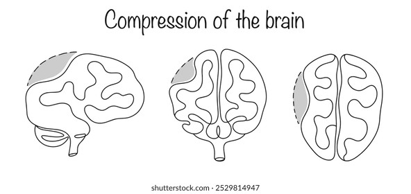 Compression of brain tissue that develops as a result of traumatic brain injury, the presence of a space-occupying formation in the cranial cavity, hydrocephalus, or cerebral edema. Medical vector.