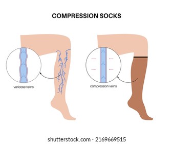 Compression Stocking Concept. Pressure Problems With Varicose Veins. Special Fitness Socks For Insufficiency Venous. Surgery Rehabilitation Clothes. Healthy Slender Female Feet Vector Illustration.