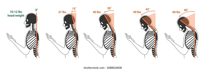 Computer neck syndrome, tech neck, text neck. Changes in pressure on the cervical spine with different head positions. Flat vector illustration is isolated on white background