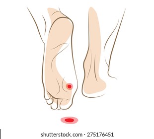 Concept of callus or plantar wart under foot, vector sketch