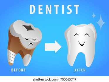 Concept of dentistry. Tooth before and after treatment, caries removal and whitening isolated on blue background vector illustration

