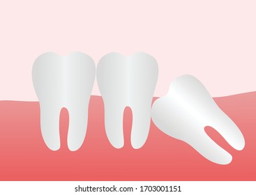 Concept of different types of wisdom teeth problems. 