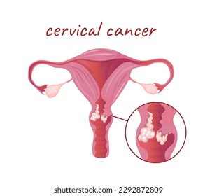 Concept Female anatomy uterus cervical cancer. This illustration depicts a flat, vector, cartoon design of the anatomy of the uterus affected by cancer. Vector illustration.