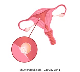 Concept Female anatomy uterus pregnancy. The illustration depicts the first stage of pregnancy, with a flat, vector-style design that conveys a modern and minimalist concept. Vector illustration.