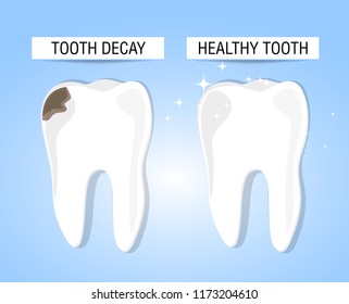 The concept of healthy and diseased tooth. Visual aid for students, dentists, patients of the clinic. Defeat caries, the focus of destruction in the teeth. Vector illustration