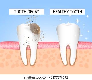 The concept of healthy and diseased tooth. Visual aid for students, dentists, patients of the clinic. Defeat caries, the focus of destruction in the teeth. Vector illustration