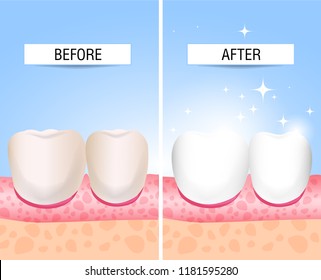 The concept of healthy and diseased tooth. Visual aid for students, dentists, patients of the clinic. Defeat caries, the focus of destruction in the teeth. Vector illustration