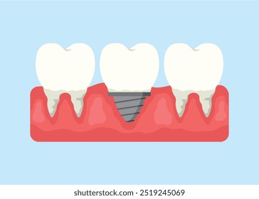 concept illustration of implanted teeth, synthetic teeth, flat style vector illustration.