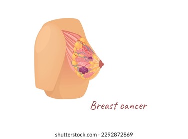 Concept Mammary glands female breast cancer. The illustration is a flat design cartoon concept of a female breast depicting the anatomy of the mammary glands affected by cancer. Vector illustration.