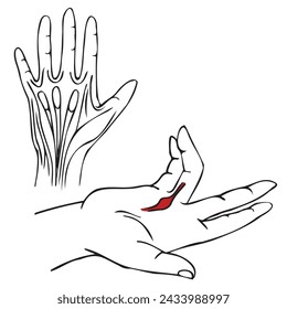 Concept for medical design. Diseases of the palms. Dupuytren's contracture. Drawing with simple black lines. Isolated vector illustration