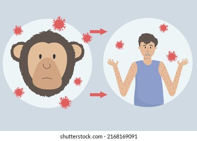The concept of monkeypox virus shows the route of infection from a monkey and the formation of rashes in humans.

