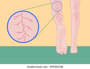 Ein Konzept von Muskel- oder Beinproblemen wie Muskelkrämpfe, Krämpfe, Krampfadern und Spinnenvenen oder Erkrankungen aufgrund von Alter oder Sport. Bearbeitbarer Clipart