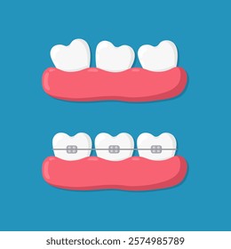 Concept of orthodontic teeth alignment with braces. Crooked teeth and smooth teeth in gum with braces installed. Orthodontic treatment design. Vector flat illustration isolated on blue background