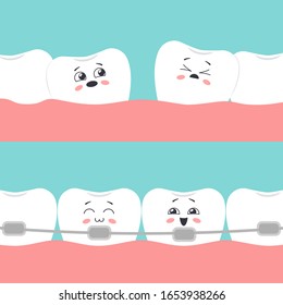 The concept of orthodontic treatment. Distorted teeth Before and straight teeth with braces After. Vector illustration