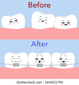 The concept of orthodontic treatment. Distorted teeth Before and straight teeth with braces After. Vector illustration