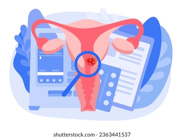 The concept of ovarian cancer. Disease of the female reproductive system. Abnormal internal organ of the uterus. Vector illustration