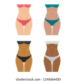 Concept of perfect body slimming weight loss liposuction. Surgical white lines on the female body, marks on the skin for plastic surgery. Vector illustration