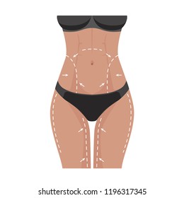 Concept of perfect body slimming weight loss liposuction. Surgical white lines on the female body, marks on the skin for plastic surgery. Vector illustration