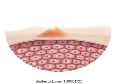 O conceito de pele que é acne ou inflamação na pele humana
É um símbolo médico para o tratamento de doenças de pele Usando drogas ou lasers para tratar.Arquivo realista de vetor.