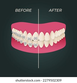 The concept of teeth alignment with braces. Orthodontic dentistry. The alignment of the teeth. Beautiful white teeth. Isolated flat vector illustration. Simple teeth in a row. Orthodontic treatment.