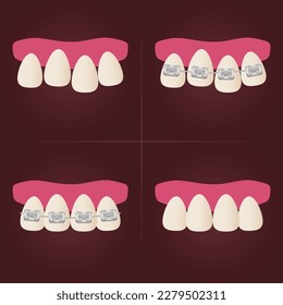 The concept of teeth alignment with braces. Orthodontic dentistry. The alignment of the teeth. Beautiful white teeth. Isolated flat vector illustration. Simple teeth in a row. Orthodontic treatment.