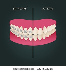 The concept of teeth alignment with braces. Orthodontic dentistry. The alignment of the teeth. Beautiful white teeth. Isolated flat vector illustration. Simple teeth in a row. Orthodontic treatment.