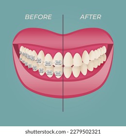 The concept of teeth alignment with braces. Orthodontic dentistry. The alignment of the teeth. Beautiful white teeth. Isolated flat vector illustration. Simple teeth in a row. Orthodontic treatment.