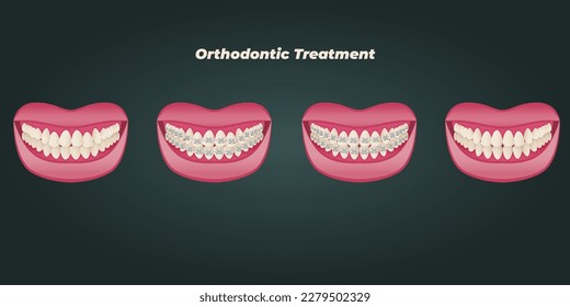 The concept of teeth alignment with braces. Orthodontic dentistry. The alignment of the teeth. Beautiful white teeth. Isolated flat vector illustration. Simple teeth in a row. Orthodontic treatment.