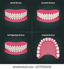 The concept of teeth alignment with braces. Orthodontic dentistry. The alignment of the teeth. Beautiful white teeth. Isolated flat vector illustration. Simple teeth in a row. Orthodontic treatment.