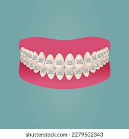 El concepto de alineación de dientes con llaves. Odontología ortodoncia. La alineación de los dientes. Bellos dientes blancos. Ilustración vectorial plana aislada. Dientes simples seguidos. Tratamiento ortodóntico.