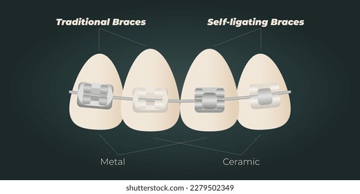 The concept of teeth alignment with braces. Orthodontic dentistry. The alignment of the teeth. Beautiful white teeth. Isolated flat vector illustration. Simple teeth in a row. Orthodontic treatment.