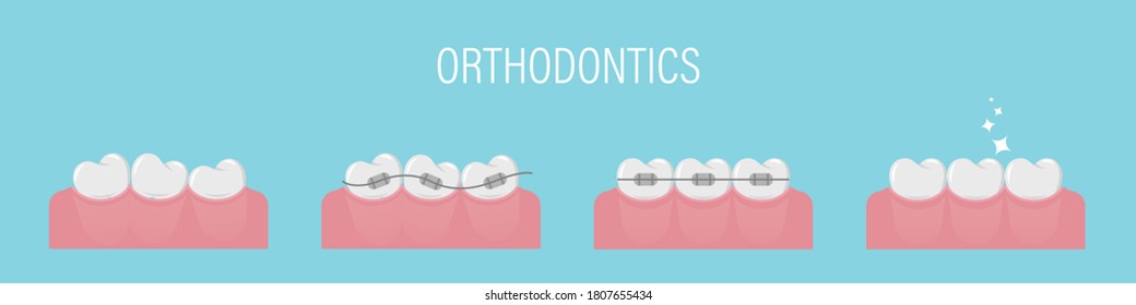 El concepto de alineación de dientes con llaves. Afiche con dientes torcidos, en cordones e incluso sanos. Dientes simples seguidos. Tratamiento ortodóntico. Ilustración vectorial aislada. Estilo plano.