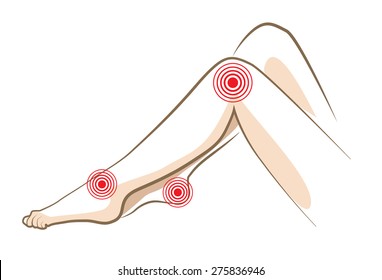 Concept of woman pain in legs, vector sketch