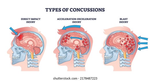 Concussion And Head Trauma Or Injury Types From Medical View Outline Diagram. Labeled Educational Anatomical Scheme With Direct Impact, Acceleration, Deceleration And Blast Causes Vector Illustration