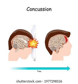 Concussion. Human's head. brain after head trauma. Vector illustration