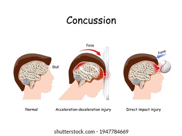 Concussion In Sport. Mild Traumatic Brain Injury (mTBI). Concussions That Caused By A Direct Blow Of A Baseball, And By Indirect Trauma To The Head. Vector Illustration. Educational Poster