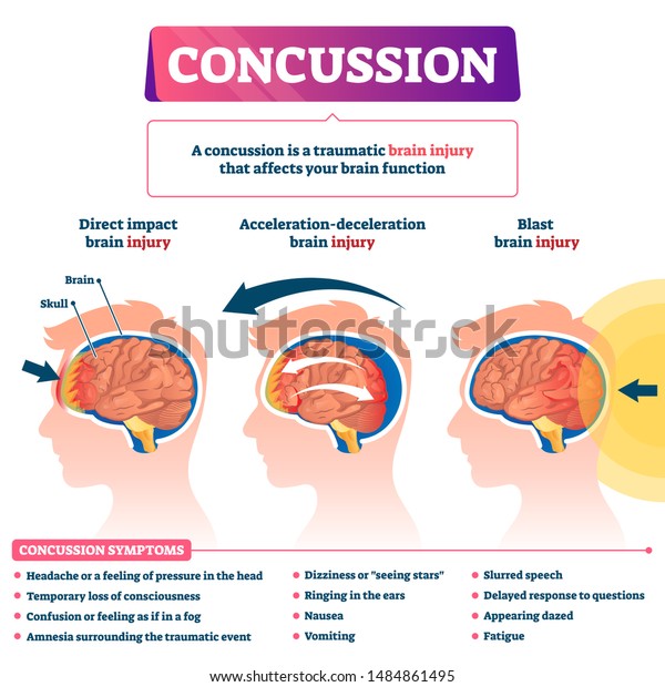 Concussion vector illustration. Labeled\
educational post head trauma scheme. Medical explanation with brain\
injury kinds. Direct impact, acceleration and blast health causes\
with symptoms list\
diagram