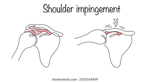 Afección caracterizada por compresión o tensión de los tendones de la articulación del hombro al mover el brazo. Un diagrama de la ocurrencia de pellizcos y dolor en la articulación del hombro. Vector.