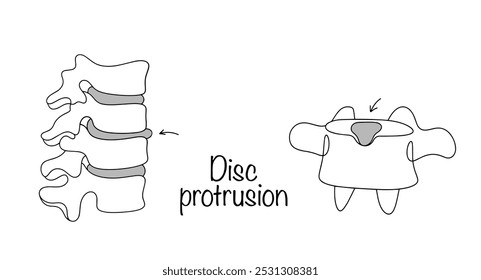 Uma condição quando o disco intervertebral é espremido no canal espinhal, mas o anel fibroso permanece intacto. Protrusão desenhada do disco intervertebral na coluna e em uma vértebra separada.