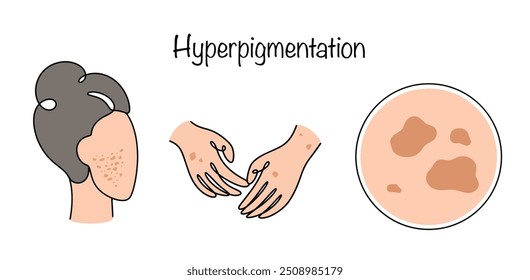 Ein Zustand, in dem dunkle Flecken auf der Haut des Gesichts und des Körpers erscheinen. Dies tritt auf, wenn die Haut extra Melanin produziert. Pigmentflecken auf der Haut von Gesicht und Händen einer Frau. Isolierter Vektor.